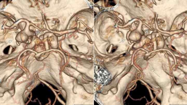 МРТ ангіографія судин головного мозку: особливості проведення процедури, розшифровка показників
